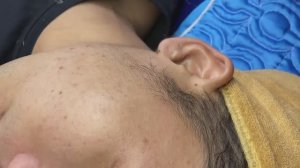 Механическая чистка лица: удаление прыщей и комедонов