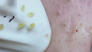 #20 Удаление прыщей. Экстрация комедонов. Подкожные прыщи. Чистка от черных точек