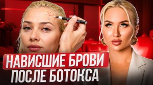 Ботокс | Нависшие брови после инъекции