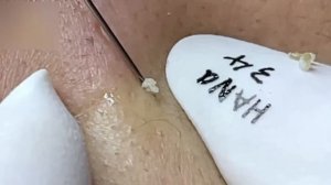 #30 Удаление прыщей. Экстрация комедонов. Подкожные прыщи. Чистка от черных точек