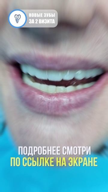Вернули пациентке очаровательную и соблазнительную улыбку. Имплантация зубов. История пациента.