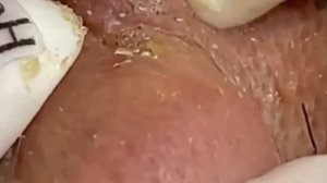 #488 Чистка лица от угрей и акне. Выдавливание прыщей. Удаление черных точек и комедонов