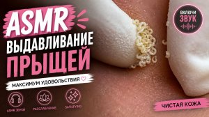 🔥 САМЫЕ ЖЁСТКИЕ ПРЫЩИ! ASMR Выдавливание Прыщей