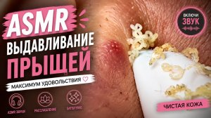 😱 ЭТО ВЫЛЕЗЛО ИЗ КОЖИ?! ASMR Выдавливание Прыщей