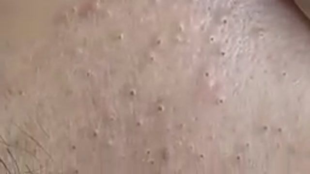 #32 Удаление прыщей. Экстрация комедонов. Подкожные прыщи. Чистка от черных точек смотреть онлайн