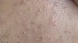 #32 Удаление прыщей. Экстрация комедонов. Подкожные прыщи. Чистка от черных точек