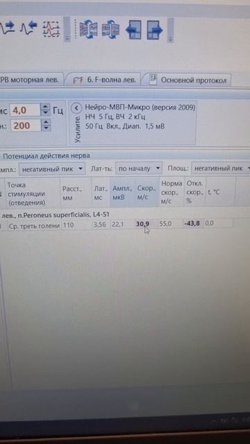 сенсорная невропатия поверхностного малоберцового нерва