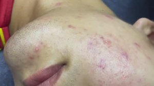 163 • Acne collection • АСМР • Relax Spa