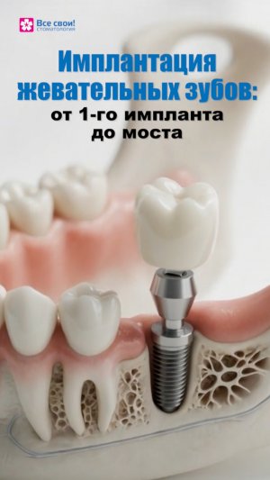 Сколько стоит поставить имплант на жевательный зуб?