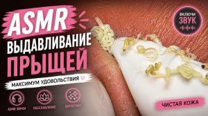 🤤 НЕРЕАЛЬНОЕ УДОВОЛЬСТВИЕ! Выдавливание Прыщей ASMR