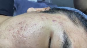 160 • Acne collection • АСМР • Relax Spa