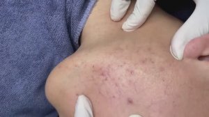 161 • Acne collection • АСМР • Relax Spa