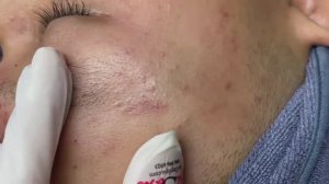 157 • Acne collection • АСМР • Relax Spa
