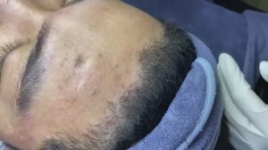 154 • Acne collection • АСМР • Relax Spa