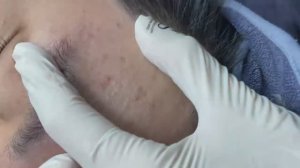 164 • Acne collection • АСМР • Relax Spa