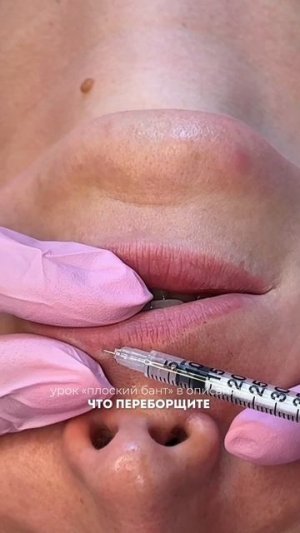 Как развернуть верхнюю губу ботоксом
