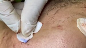 ASMR удаление подкожных прыщей.