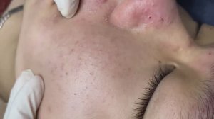 159 • Acne collection • АСМР • Relax Spa