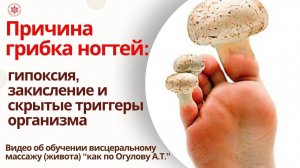 Причина грибка ногтей: гипоксия, закисление и скрытые триггеры организма. Видео об обучении