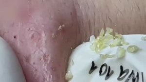 #34 Удаление прыщей. Экстрация комедонов. Подкожные прыщи. Чистка от черных точек