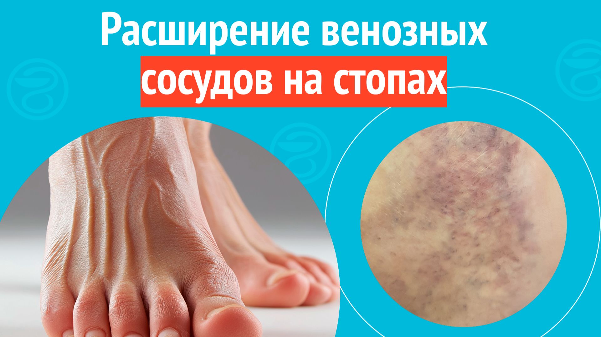 🦶 Расширение венозных сосудов на стопах. Клинический случай № 1793 смотреть онлайн
