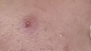 Удаление подкожных прыщей иглой