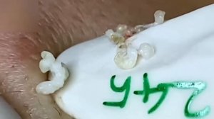 #43 Удаление акне. Экстрация комедонов. Подкожные прыщи. Чистка от черных
