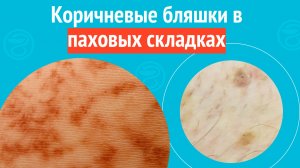 👉 Коричневые бляшки в паховых складках. Клинический случай № 1795