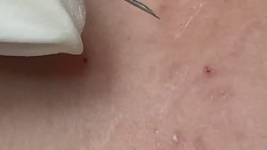 Удаление подкожных прыщей иглой