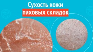 🫤 Сухость кожи паховых складок. Клинический случай № 1794