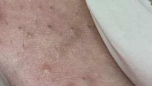 Удаление черных точек и белых угрей