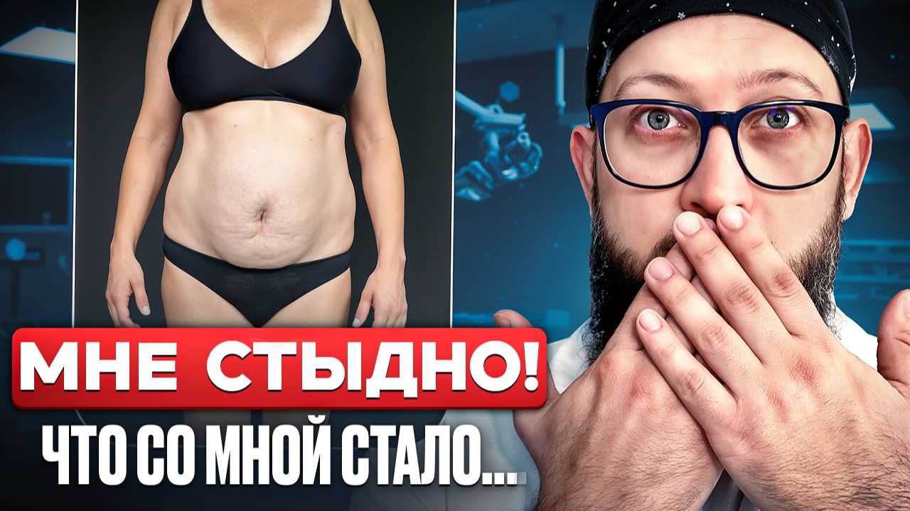 После 3 родов я НЕ МОГЛА СМОТРЕТЬ НА СВОЙ ЖИВОТ…реальная история пациентки