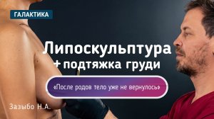 Липосакция, липофилинг и подтяжка груди | Анна после родов у Николая Зазыбо