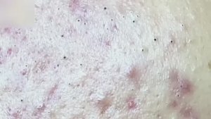 #47 Удаление прыщей. Экстрация комедонов. Подкожные прыщи. Чистка от черных точек