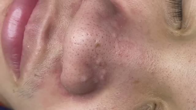 168 • Acne collection • АСМР • Relax Spa смотреть онлайн