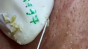 #54 Удаление прыщей. Экстрация комедонов. Подкожные прыщи. Чистка от черных точек
