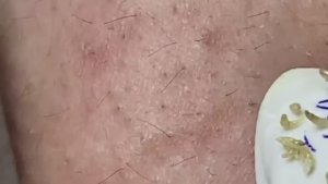 Удаление акне и черных точек: Показываем на приме