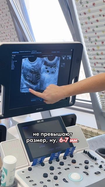 Планирование беременности при синдроме поликистозных яичников (СПКЯ) 🍇