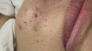 172 • Acne collection • АСМР • Relax Spa