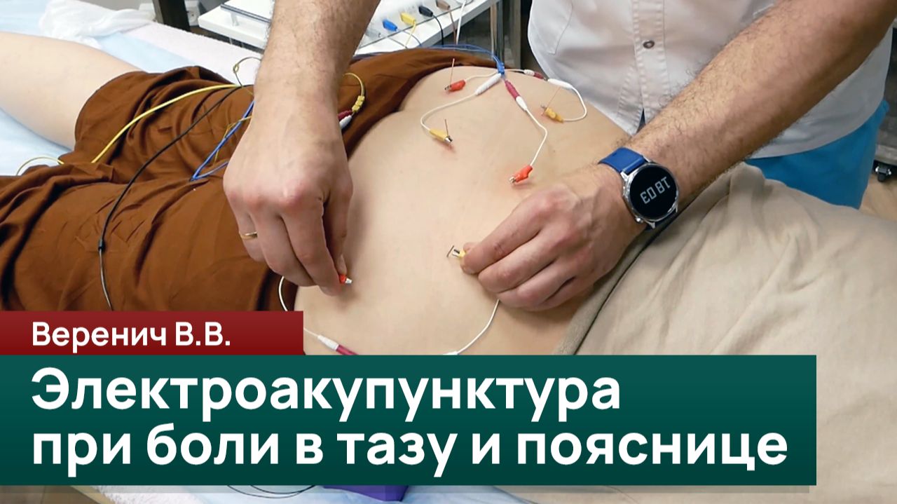 Электро-акупунктурная стимуляция в рамках работы с болевым синдромом в области таза и поясницы. Вере смотреть онлайн