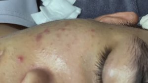 #57 Удаление прыщей. Экстрация комедонов. Подкожные прыщи. Чистка от черных точек