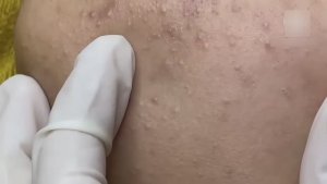 Множественные удаления закрытых комедонов