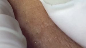 Удаление закрытых комедонов, которые долго не лечили. Часть 1