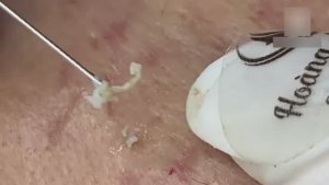 Удаление закрытых комедонов, которые долго не лечили. Часть 2