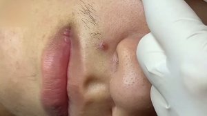 #56 Удаление прыщей. Экстрация комедонов. Подкожные прыщи. Чистка от черных точек