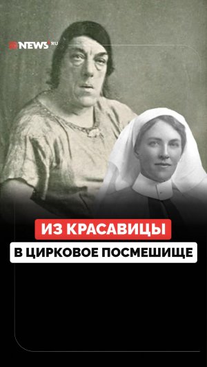Стала «самой уродливой женщиной в мире», чтобы прокормить семью: редкая болезнь Мэри Энн Беван