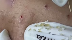 #60 Удаление прыщей. Экстрация комедонов. Подкожные прыщи. Чистка от черных точек
