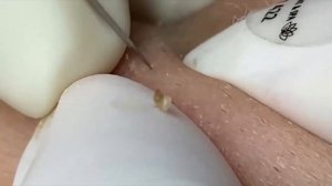 Глубокая чистка кожи от прыщей и сальных пробок