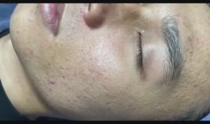 Полное удаление комедонов с лица