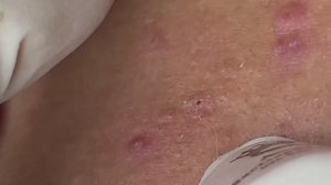 Удаление воспалительных прыщей